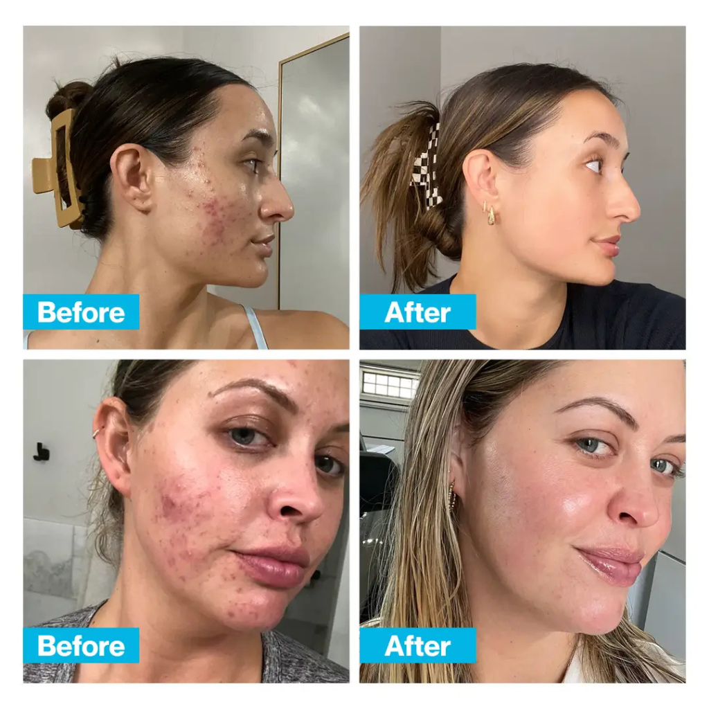 CLEARSKIN™ Hormonal Acne Supplement